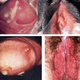 Illustration for article titled Obat Penyakit Sipilis Alamiem/em